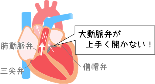 医師は大動脈弁狭窄症の雑音をどのように治療しますか?