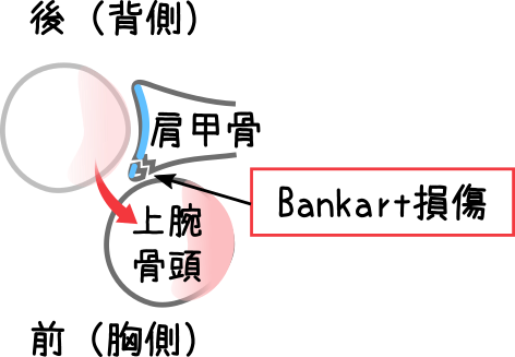 バンカート(Bankart)損傷