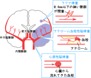洞不全症候群(SSS) | 見て！わかる！病態生理と看護【花子の