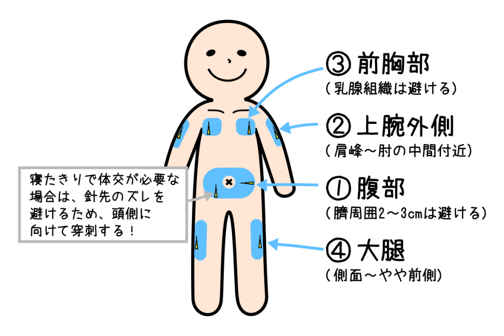 持続皮下注の穿刺部位