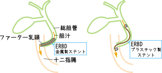 ERBDチューブの種類イメージ