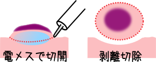 ESD(内視鏡的粘膜下層剥離術)イメージ図