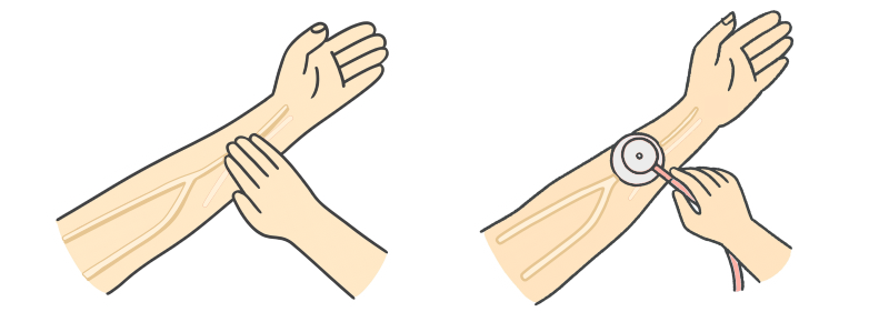 透析患者の観察ーシャント音・スリル