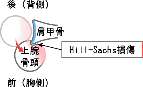 ヒル・サックス(Hill-Sachs)損傷