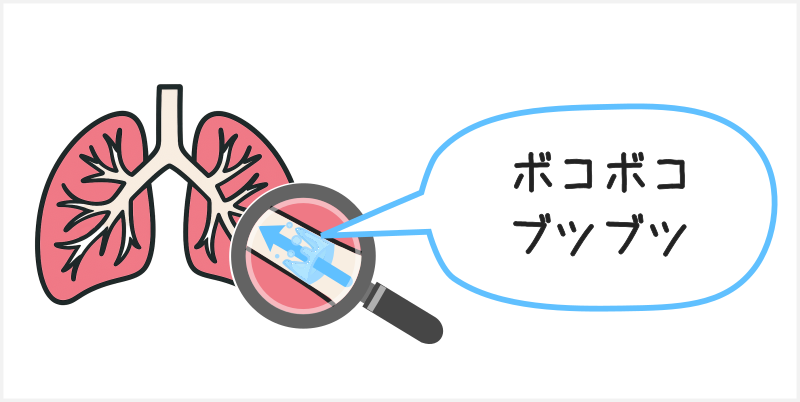 呼吸音の異常(副雑音）②水泡音（Coarse crackles）