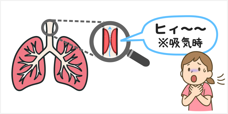 呼吸音の異常(副雑音）⑤吸気性喘鳴（Stridor）