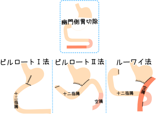幽門側胃切除術ビルロード法イメージ図