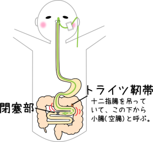 経皮経肝的胆道ドレナージ(PTBD) | 見て！わかる！病態生理と看護【花子のまとめノート】