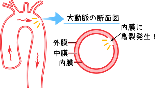 大動脈解離の病態１、大動脈内膜に亀裂が発生したイメージ図