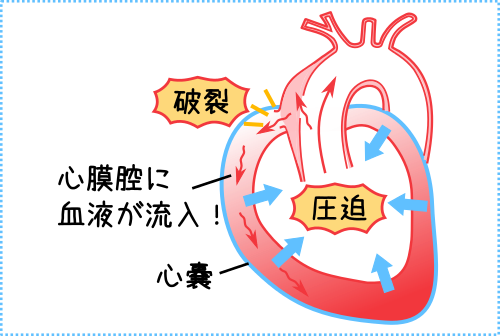 大動脈解離の病態生理３、大動脈破裂発生時のイメージ図