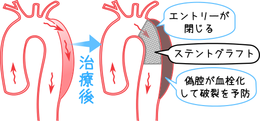 大動脈解離ステントグラフトイメージ図