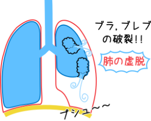 洞不全症候群(SSS) | 見て！わかる！病態生理と看護【花子のまとめノート】