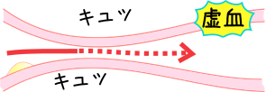 異型狭心症の血管が狭まったイメージ図