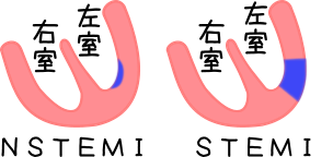 STEMIとNSTEMIのイメージ図