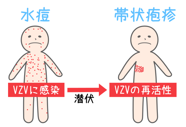 水痘と帯状疱疹の違い