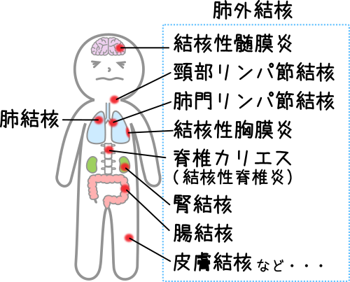 肺結核と肺外結核イメージ図