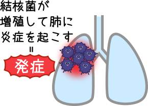 結核菌が免疫を逃れ発病するイメージ図