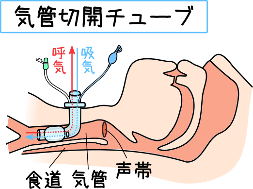 気管切開とは何ですか?